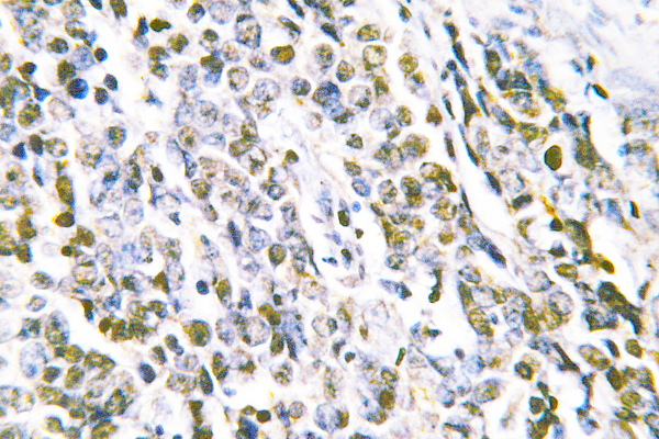 MRE11A / MRE11 Antibody - IHC of MRE11 (L260) pAb in paraffin-embedded human lung carcinoma tissue.