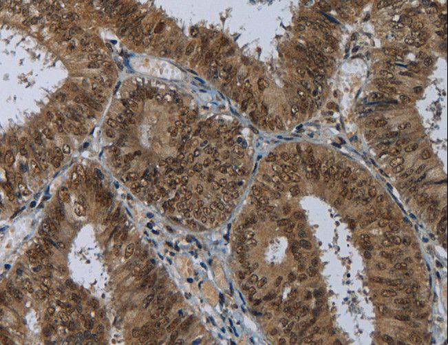 MRE11A / MRE11 Antibody - Immunohistochemistry of paraffin-embedded Human colon cancer using MRE11A Polyclonal Antibody at dilution of 1:60.