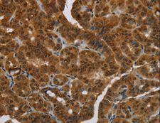 MRE11A / MRE11 Antibody - Immunohistochemistry of paraffin-embedded Human breast cancer using MRE11A Polyclonal Antibody at dilution of 1:60.