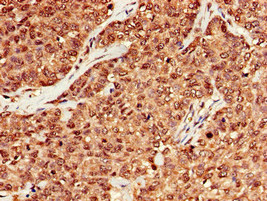 MRE11A / MRE11 Antibody - Immunohistochemistry of paraffin-embedded human ovarian cancer at dilution of 1:100