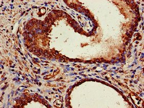 MRE11A / MRE11 Antibody - Immunohistochemistry of paraffin-embedded human prostate cancer at dilution of 1:100