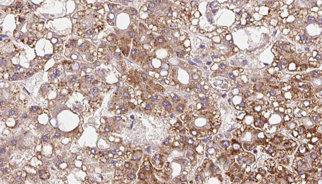 MRGPRF Antibody - 1:100 staining human liver carcinoma tissues by IHC-P. The sample was formaldehyde fixed and a heat mediated antigen retrieval step in citrate buffer was performed. The sample was then blocked and incubated with the antibody for 1.5 hours at 22°C. An HRP conjugated goat anti-rabbit antibody was used as the secondary.