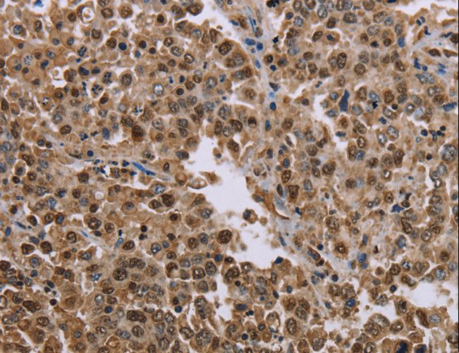 MRGX1 / MRGPRX1 Antibody - Immunohistochemistry of paraffin-embedded Human liver cancer using MRGPRX1 Polyclonal Antibody at dilution of 1:40.