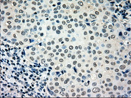 MRI1 Antibody - Immunohistochemical staining of paraffin-embedded Adenocarcinoma of breast tissue using anti-MRI1 mouse monoclonal antibody. (Dilution 1:50).