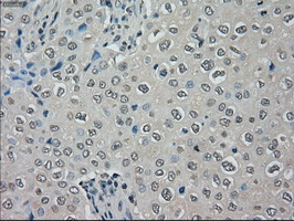 MRI1 Antibody - IHC of paraffin-embedded Adenocarcinoma of breast tissue using anti-MRI1 mouse monoclonal antibody. (Dilution 1:50).