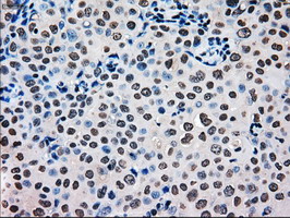 MRI1 Antibody - IHC of paraffin-embedded Adenocarcinoma of breast tissue using anti-MRI1 mouse monoclonal antibody. (Dilution 1:50).