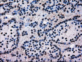 MRI1 Antibody - IHC of paraffin-embedded Carcinoma of kidney tissue using anti-MRI1 mouse monoclonal antibody. (Dilution 1:50).