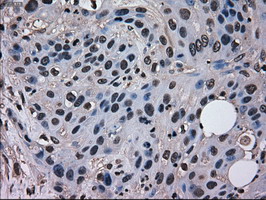 MRI1 Antibody - IHC of paraffin-embedded Carcinoma of pancreas tissue using anti-MRI1 mouse monoclonal antibody. (Dilution 1:50).