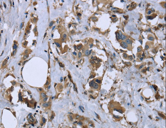 MRLC2 / MYL12B Antibody - Immunohistochemistry of paraffin-embedded Human breast cancer using MYL12B Polyclonal Antibody at dilution of 1:20.