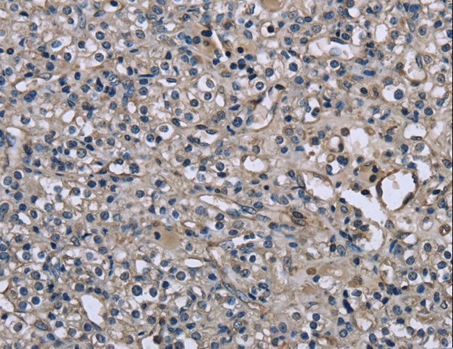 MRLC2 / MYL12B Antibody - Immunohistochemistry of paraffin-embedded Human prostate cancer using MYL12B Polyclonal Antibody at dilution of 1:25.