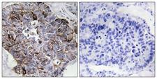 MRLC2 / MYL12B Antibody - Peptide - + Immunohistochemistry analysis of paraffin-embedded human lung carcinoma tissue using Myosin regulatory light chain 2 (Ab-18) antibody.