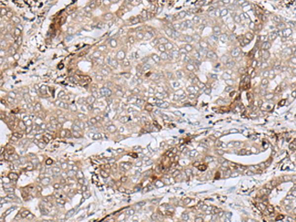 MRM1 Antibody - Immunohistochemistry of paraffin-embedded Human liver cancer tissue  using MRM1 Polyclonal Antibody at dilution of 1:85(×200)