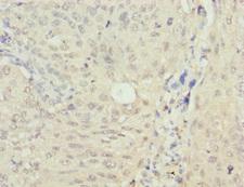 MRNP41 / RAE1 Antibody - Immunohistochemistry of paraffin-embedded human lung cancer at dilution 1:100