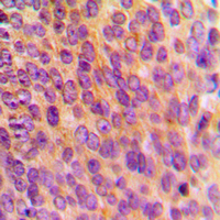 MRPL10 Antibody - Immunohistochemical analysis of MRPL10 staining in human breast cancer formalin fixed paraffin embedded tissue section. The section was pre-treated using heat mediated antigen retrieval with sodium citrate buffer (pH 6.0). The section was then incubated with the antibody at room temperature and detected using an HRP conjugated compact polymer system. DAB was used as the chromogen. The section was then counterstained with hematoxylin and mounted with DPX.