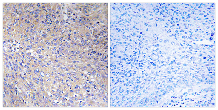 MRPL11 Antibody - Immunohistochemistry analysis of paraffin-embedded human cervix carcinoma tissue, using MRPL11 Antibody. The picture on the right is blocked with the synthesized peptide.