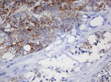 MRPL11 Antibody - IHC of paraffin-embedded Adenocarcinoma of Human colon tissue using anti-MRPL11 mouse monoclonal antibody. (Heat-induced epitope retrieval by 10mM citric buffer, pH6.0, 120°C for 3min).