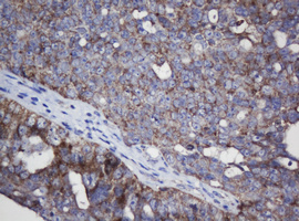 MRPL11 Antibody - IHC of paraffin-embedded Adenocarcinoma of Human ovary tissue using anti-MRPL11 mouse monoclonal antibody. (Heat-induced epitope retrieval by 10mM citric buffer, pH6.0, 120°C for 3min).
