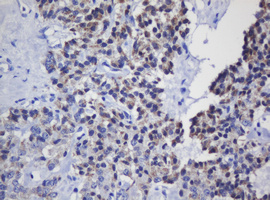 MRPL11 Antibody - IHC of paraffin-embedded Carcinoma of Human pancreas tissue using anti-MRPL11 mouse monoclonal antibody. (Heat-induced epitope retrieval by 10mM citric buffer, pH6.0, 120°C for 3min).