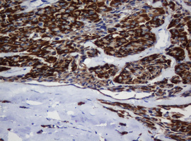 MRPL11 Antibody - IHC of paraffin-embedded Carcinoma of Human thyroid tissue using anti-MRPL11 mouse monoclonal antibody. (Heat-induced epitope retrieval by 10mM citric buffer, pH6.0, 120°C for 3min).