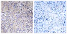 MRPL11 Antibody - Peptide - + Immunohistochemistry analysis of paraffin-embedded human cervix carcinoma tissue using MRPL11 antibody.