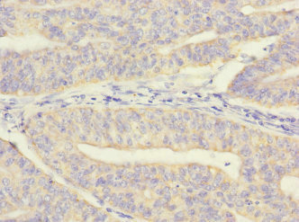 MRPL12 Antibody - Immunohistochemistry of paraffin-embedded human endometrial cancer at dilution 1:100