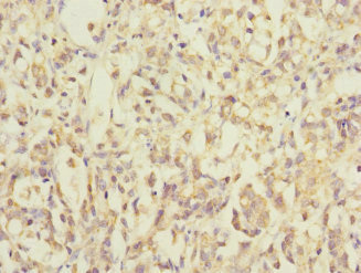 MRPL12 Antibody - Immunohistochemistry of paraffin-embedded human gastric cancer at dilution 1:100