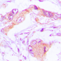 MRPL13 Antibody - Immunohistochemical analysis of MRPL13 staining in human lung formalin fixed paraffin embedded tissue section. The section was pre-treated using heat mediated antigen retrieval with sodium citrate buffer (pH 6.0). The section was then incubated with the antibody at room temperature and detected using an HRP conjugated compact polymer system. DAB was used as the chromogen. The section was then counterstained with hematoxylin and mounted with DPX.
