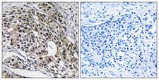 MRPL13 Antibody - Peptide - + Immunohistochemistry analysis of paraffin-embedded human breast carcinoma tissue using MRPL13 antibody.