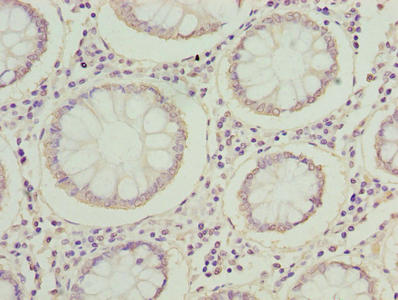 MRPL14 Antibody - Immunohistochemistry of paraffin-embedded human colon cancer using MRPL14 Antibody at dilution of 1:100