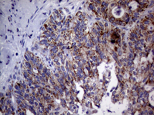 MRPL15 Antibody - Immunohistochemical staining of paraffin-embedded Adenocarcinoma of Human ovary tissue using anti-MRPL15 mouse monoclonal antibody. (Heat-induced epitope retrieval by 1mM EDTA in 10mM Tris buffer. (pH8.5) at 120°C for 3 min. (1:500)
