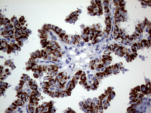 MRPL15 Antibody - Immunohistochemical staining of paraffin-embedded Carcinoma of Human thyroid tissue using anti-MRPL15 mouse monoclonal antibody. (Heat-induced epitope retrieval by 1mM EDTA in 10mM Tris buffer. (pH8.5) at 120°C for 3 min. (1:500)