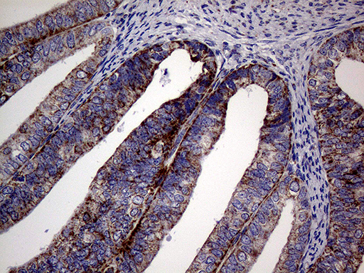 MRPL15 Antibody - Immunohistochemical staining of paraffin-embedded Adenocarcinoma of Human endometrium tissue using anti-MRPL15 mouse monoclonal antibody. (Heat-induced epitope retrieval by 1mM EDTA in 10mM Tris buffer. (pH8.5) at 120°C for 3 min. (1:500)