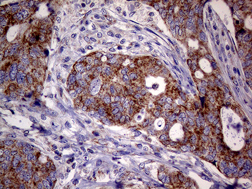 MRPL15 Antibody - Immunohistochemical staining of paraffin-embedded Adenocarcinoma of Human breast tissue tissue using anti-MRPL15 mouse monoclonal antibody. (Heat-induced epitope retrieval by 1mM EDTA in 10mM Tris buffer. (pH8.5) at 120°C for 3 min. (1:500)