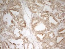 MRPL15 Antibody - Immunohistochemical staining of paraffin-embedded Human thyroid tissue within the normal limits using anti-MRPL15 mouse monoclonal antibody. (Heat-induced epitope retrieval by 1 mM EDTA in 10mM Tris, pH8.5, 120C for 3min,