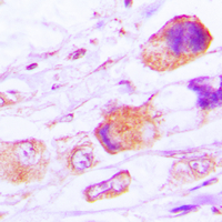MRPL15 Antibody - Immunohistochemical analysis of MRPL15 staining in human lung cancer formalin fixed paraffin embedded tissue section. The section was pre-treated using heat mediated antigen retrieval with sodium citrate buffer (pH 6.0). The section was then incubated with the antibody at room temperature and detected using an HRP conjugated compact polymer system. DAB was used as the chromogen. The section was then counterstained with hematoxylin and mounted with DPX.