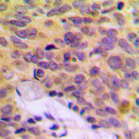 MRPL16 Antibody - Immunohistochemical analysis of MRPL16 staining in human breast cancer formalin fixed paraffin embedded tissue section. The section was pre-treated using heat mediated antigen retrieval with sodium citrate buffer (pH 6.0). The section was then incubated with the antibody at room temperature and detected using an HRP conjugated compact polymer system. DAB was used as the chromogen. The section was then counterstained with hematoxylin and mounted with DPX.