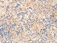 MRPL16 Antibody - Immunohistochemistry of paraffin-embedded Human liver cancer tissue  using MRPL16 Polyclonal Antibody at dilution of 1:60(×200)