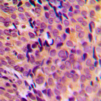 MRPL17 Antibody - Immunohistochemical analysis of MRPL17 staining in human breast cancer formalin fixed paraffin embedded tissue section. The section was pre-treated using heat mediated antigen retrieval with sodium citrate buffer (pH 6.0). The section was then incubated with the antibody at room temperature and detected using an HRP conjugated compact polymer system. DAB was used as the chromogen. The section was then counterstained with hematoxylin and mounted with DPX.