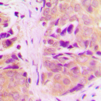 MRPL18 Antibody - Immunohistochemical analysis of MRPL18 staining in human breast cancer formalin fixed paraffin embedded tissue section. The section was pre-treated using heat mediated antigen retrieval with sodium citrate buffer (pH 6.0). The section was then incubated with the antibody at room temperature and detected using an HRP conjugated compact polymer system. DAB was used as the chromogen. The section was then counterstained with hematoxylin and mounted with DPX.