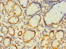 MRPL2 Antibody - Immunohistochemistry of paraffin-embedded human gastric cancer using MRPL2 Antibody at dilution of 1:100