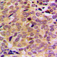 MRPL21 Antibody - Immunohistochemical analysis of MRPL21 staining in human breast cancer formalin fixed paraffin embedded tissue section. The section was pre-treated using heat mediated antigen retrieval with sodium citrate buffer (pH 6.0). The section was then incubated with the antibody at room temperature and detected using an HRP conjugated compact polymer system. DAB was used as the chromogen. The section was then counterstained with hematoxylin and mounted with DPX.