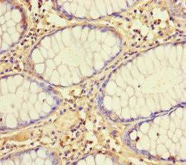 MRPL21 Antibody - Immunohistochemistry of paraffin-embedded human colon cancer using MRPL21 Antibody at dilution of 1:100