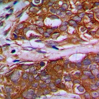 MRPL22 Antibody - Immunohistochemical analysis of MRPL22 staining in human prostate cancer formalin fixed paraffin embedded tissue section. The section was pre-treated using heat mediated antigen retrieval with sodium citrate buffer (pH 6.0). The section was then incubated with the antibody at room temperature and detected with HRP and DAB as chromogen. The section was then counterstained with hematoxylin and mounted with DPX.
