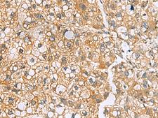 MRPL22 Antibody - Immunohistochemistry of paraffin-embedded Human liver cancer tissue  using MRPL22 Polyclonal Antibody at dilution of 1:50(×200)