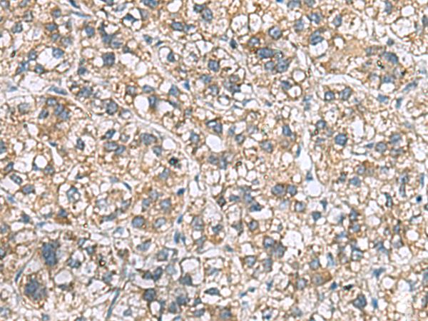 MRPL22 Antibody - Immunohistochemistry of paraffin-embedded Human liver cancer tissue  using MRPL22 Polyclonal Antibody at dilution of 1:60(×200)