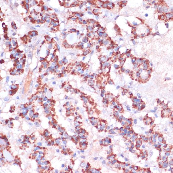 MRPL23 Antibody - Immunohistochemistry of paraffin-embedded Human thyroid cancer using MRPL23 Polyclonal Antibody at dilution of 1:100 (40x lens).