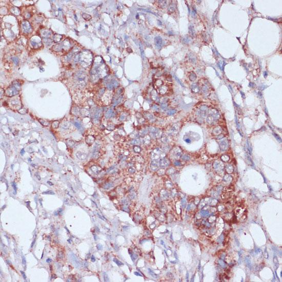 MRPL23 Antibody - Immunohistochemistry of paraffin-embedded Human colon carcinoma using MRPL23 Polyclonal Antibody at dilution of 1:100 (40x lens).