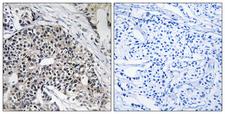 MRPL24 Antibody - Peptide - + Immunohistochemistry analysis of paraffin-embedded human breast carcinoma tissue using MRPL24 antibody.