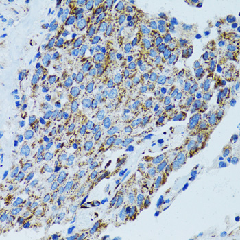 MRPL28 Antibody - Immunohistochemistry of paraffin-embedded human lung cancer tissue.