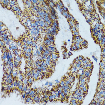 MRPL28 Antibody - Immunohistochemistry of paraffin-embedded human gastric cancer tissue.